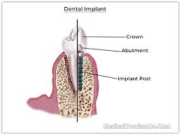 Check spelling or type a new query. Cost Of Dental Implants Chandigarh India Safe Affordable Implants