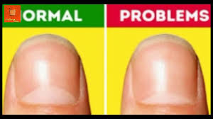 Color Of Fingernails And Toenails Health Indicator Chart Health Cuttingchai Trending Hindinews