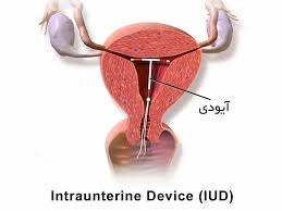 Image result for ‫احتمال بارداری با IUD چقدر است؟‬‎