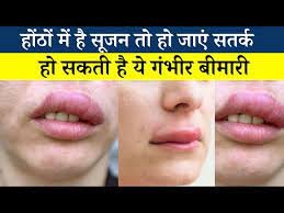 causes of angioedema ह ठ म स जन