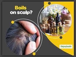 boils on scalp here are 5 useful home