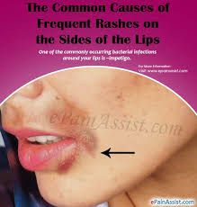 rashes on the sides of the lips tips