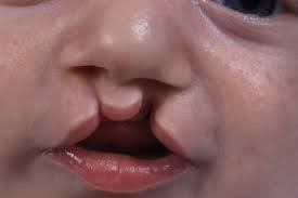 cleft lip and palate nhs