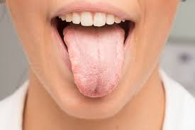 For example, candidiasis in the mouth, throat, or esophagus is uncommon in healthy adults. Mundsoor Pilzbefall In Der Mundhohle Ratgeber Apobag Osterreich