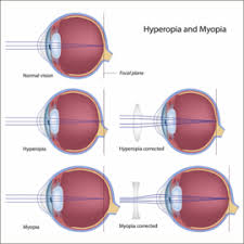 Myopia And Hypermetropia Optical Masters Of Denver