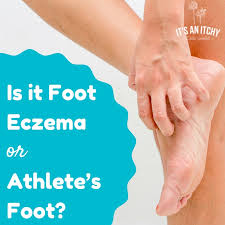 is it foot eczema or something else