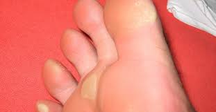 yellow feet 6 potential causes