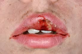 infected split lip stock image c045
