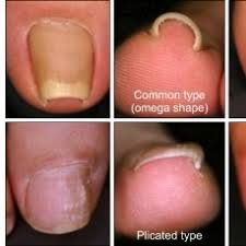 types of pincer nails cited from ref