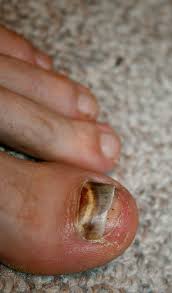 black toenails how to avoid and deal