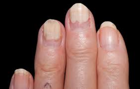 common nail problems ingrown nails