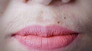 electrolysis for upper lip chin hair