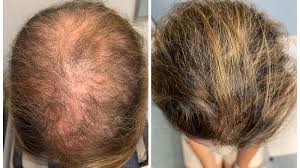 an old cine remes hair loss for