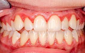 what is gingivitis 7 home remes