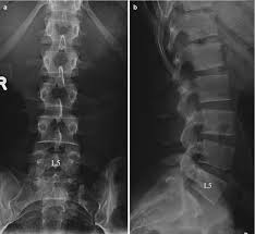 spine radiology key