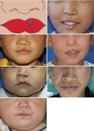 clification of cleft lip and palate