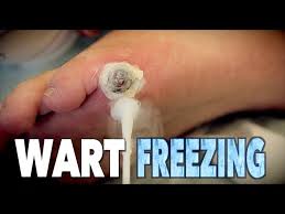 giant wart freezing with liquid