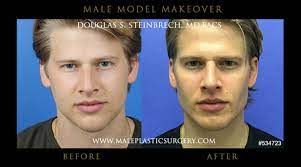 model make over gallerymale plastic surgery