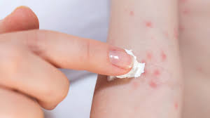 treating an allergic skin reaction
