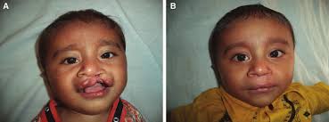 boy with unilateral complete cleft lip