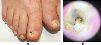 diagnosis management of onychomycosis