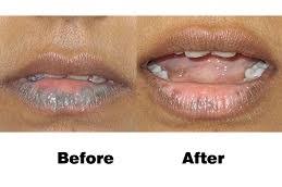 laser treatment for dark lips in dubai