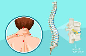 pinched spinal nerve cervical