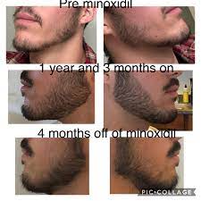 Loading beard's progress after 13 months of minoxidil application. After 1 Year And 3 Months Of Minoxidil Foam 5 I Stopped For Approximately 4 Months And Lost A Lot Of My Gains I M Trying Again For Another Year With A Derma
