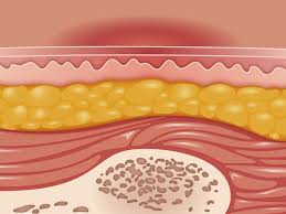 skin ulcer types symptoms causes