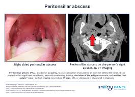 peritonsillar abscess pance eent