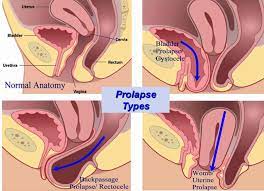 pelvic organ prolapse surgery