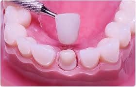 why are dental crowns important