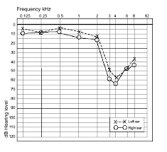 Typical Audiogram Showing A Noise Induced Hearing Loss