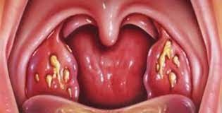 Il tumore alla laringe si divide in: Tutti I Sintomi Del Cancro Alla Gola E Come Prevenirlo In Modo Naturale Rimedio Naturale