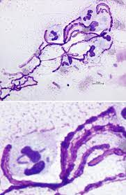 mucoid pseudomonas aeruginosa infection