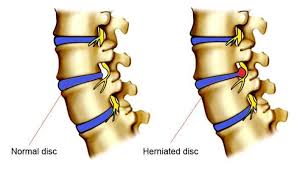 lumbar discs with chiropractic therapy