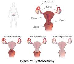 pain after hysterectomy pelvic