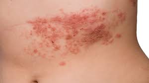 Oral antifungal pills if the areas are also infected with yeast. Is It Shingles Virus Or Something Else Everyday Health