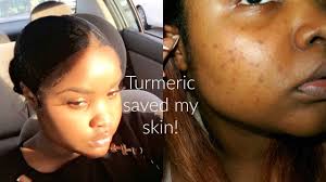 my acne scarring over night turmeric