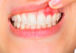 how to get rid of gingivitis that s