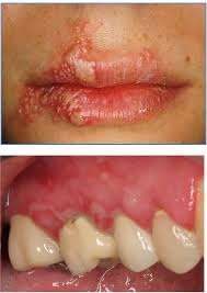 benign infectious lesions conditions of
