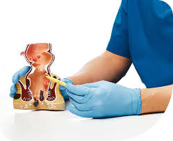 Laser might be worth the expense of $100 to $250 per treatment. Pilonidal Cyst Sinus Treatment Best Pilonidal Sinus Doctor