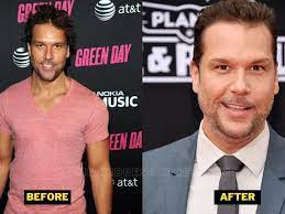 Dane Cook Plastic Surgery. What Happened To Him And His Face?
