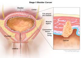Bladder Cancer Treatment Pdq Health Professional Version