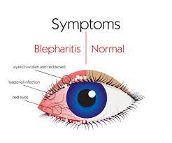 blepharitis symptoms causes treatment