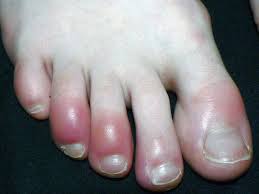 How is a broken big toe treated? Broken Pinky Toe Symptoms Treatment And Other Conditions