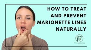 prevent marionette lines naturally