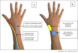 They have blood vessels and cells to maintain tendon health and repair injured the fcr tendon is one of two tendons that bend the wrist. Distal Intersection Syndrome An Unusual Cause Of Forearm Pain Reumatologia Clinica