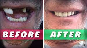 diy dentures temporary tooth 6