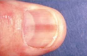 pink line or stripe on fingernail or